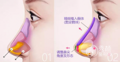 <b>假体隆鼻整形有哪些后遗症？</b>