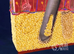 <b>负压吸脂|水动力吸脂|光纤溶脂|射频溶脂|超声波吸脂|冷冻溶脂优缺点对比。</b>
