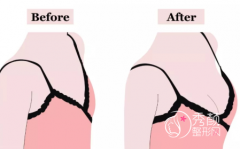 <b>自体脂肪隆胸一般需要多少钱?贵不贵?要填充几次?</b>