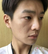 <b>面部超声提拉提升多少钱（附面部提升案例）</b>