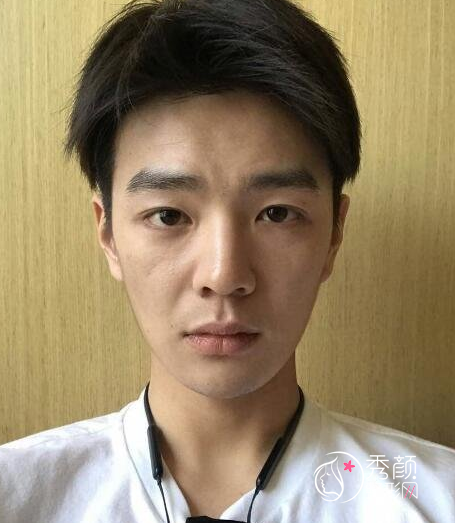 面部超声提拉提升多少钱（附面部提升案例）