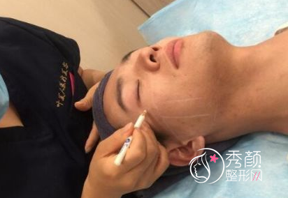 面部超声提拉提升多少钱（附面部提升案例）