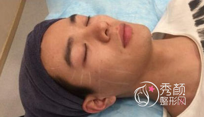 面部超声提拉提升多少钱（附面部提升案例）