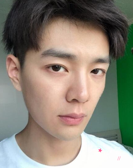 面部超声提拉提升多少钱（附面部提升案例）