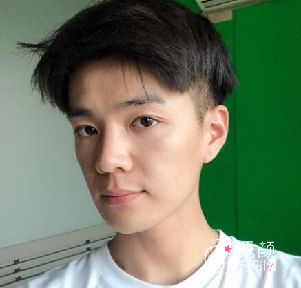 面部超声提拉提升多少钱（附面部提升案例）