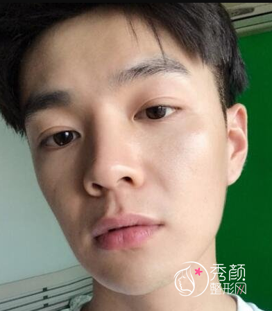 面部超声提拉提升多少钱（附面部提升案例）