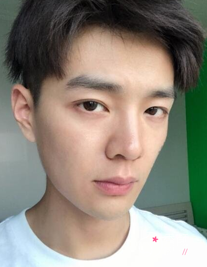 面部超声提拉提升多少钱（附面部提升案例）