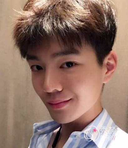 面部超声提拉提升多少钱（附面部提升案例）