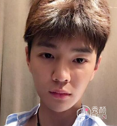 面部超声提拉提升多少钱（附面部提升案例）