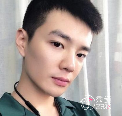 面部超声提拉提升多少钱（附面部提升案例）