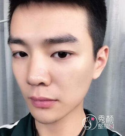 面部超声提拉提升多少钱（附面部提升案例）