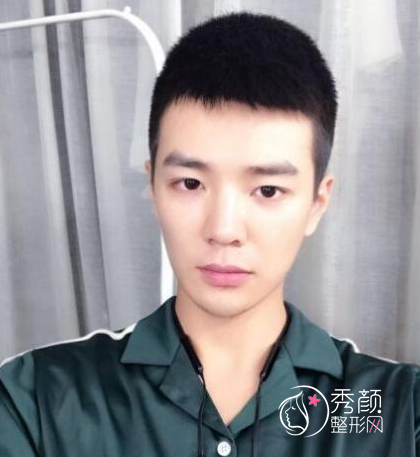 面部超声提拉提升多少钱（附面部提升案例）