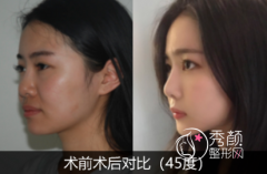 正颌手术后要不要取出钛板呢？