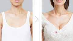 北京隆胸多少钱|北京隆胸价格表一览