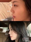 【隆鼻案例分享】5万块做的鼻部手术妥妥的稳了
