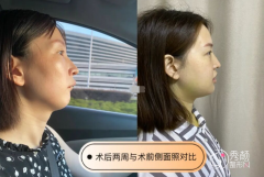 2021上海九院正畸正颌费用,九院正颌手术哪个医生好