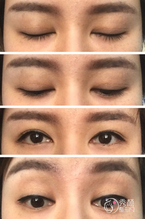 陈芝和潘贰谁双眼皮修复的好|技术风格审美案例对比