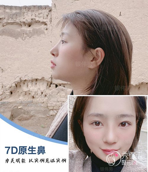 四川友谊医院银伟男隆鼻怎么样