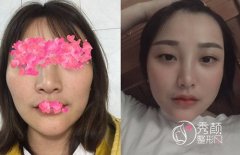 <b>首尔丽格崔荣达做的颧骨和下颌角手术怎样？</b>
