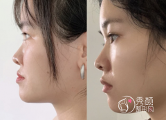 北京隆鼻/鼻修复哪个医生好,医生技术审美整理。