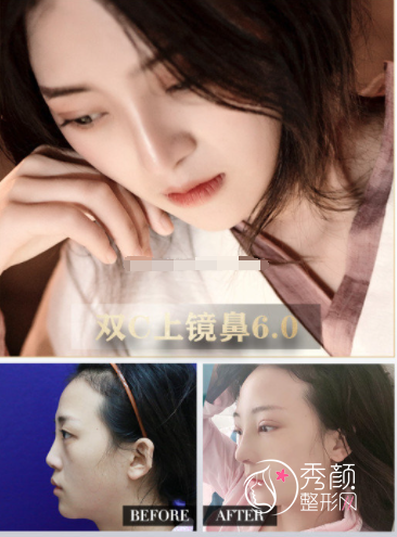 南京连天美周长兵隆鼻怎么样，有没有失败案例？