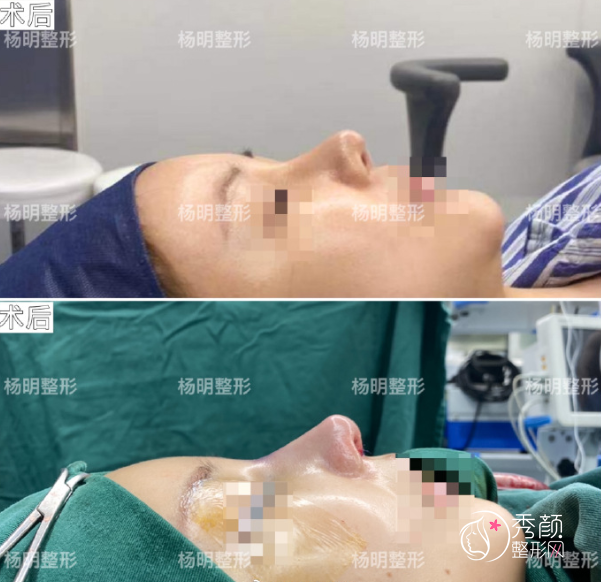 曝光上海鲁南门诊杨明做鼻子好吗