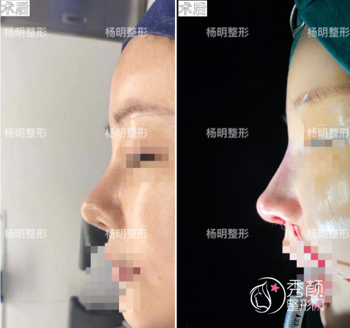 曝光上海鲁南门诊杨明做鼻子好吗