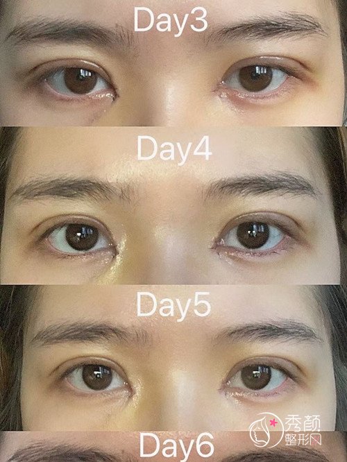 西安医学院第二附属医院陈杰做双眼皮怎么样