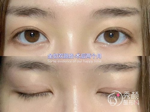 西安医学院第二附属医院陈杰做双眼皮怎么样