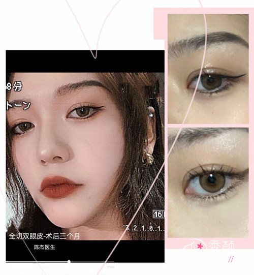 西安医学院第二附属医院陈杰做双眼皮怎么样