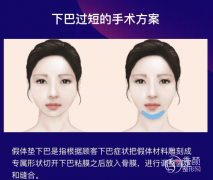 <b>上海垫下巴手术一般需要多少钱？</b>