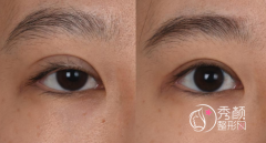 上海九院做双眼皮修复怎么样,哪个医生好？