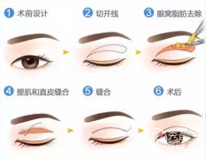 <b>割双眼皮手术流程</b>