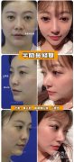 <b>上海喜美王会勇做隆鼻/鼻修复技术怎么样</b>