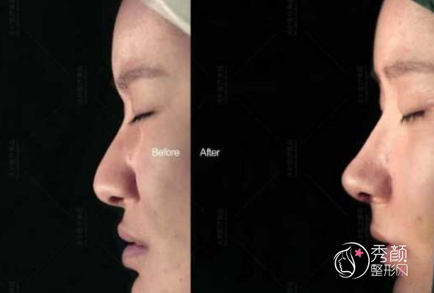 北京隆鼻胡俊峰和刘彦军哪个好 谁没有黑料