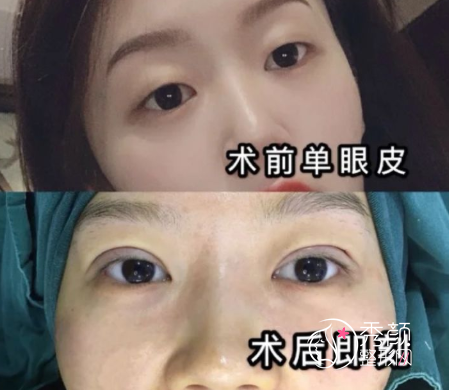 上海九院苏薇洁双眼皮修复怎么样