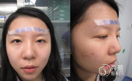 成都成美冯春雨做鼻子怎么样，隆鼻案例来对比。