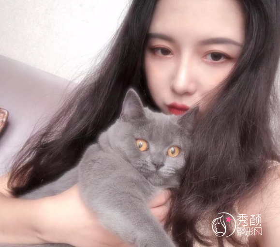 成都成美冯春雨做鼻子怎么样，隆鼻案例来对比。