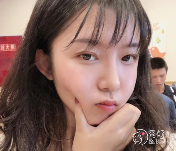 成都成美冯春雨做鼻子怎么样，隆鼻案例来对比。