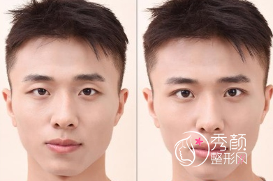 成都成美王立鹏割双眼皮/双眼皮修复技术怎么样