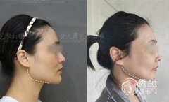 北京黄大勇磨骨价格多少钱