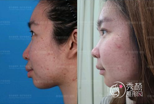 北京八大处杨斌和联合丽格柳春明哪个正颌手术做得好？