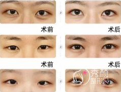 <b>青岛哪家整形医院做双眼皮果好？</b>
