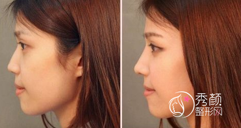 上海华美做隆鼻失败修复手术需要多少钱？