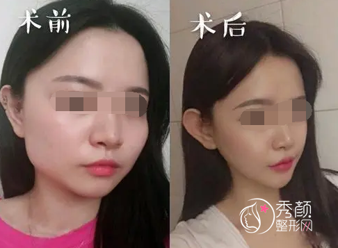 何晋龙磨骨有失败案例吗？