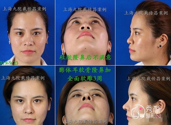 上海九院戴传昌隆鼻技术怎么样,有没有失败案例？
