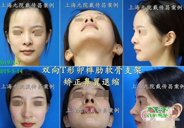 上海九院戴传昌隆鼻技术怎么样,有没有失败案例？