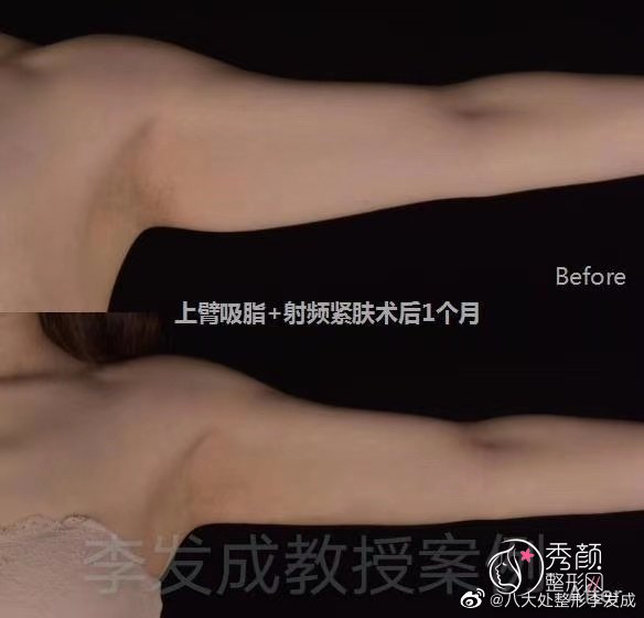 北京八大处李发成吸脂怎么样,有没有失败案例？