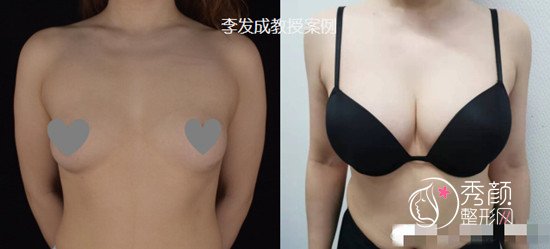 北京八大处李发成隆胸怎么样，有没有失败案例？