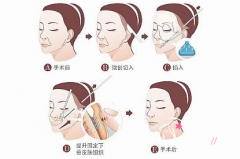 上海首尔丽格整形医院哪个医生做拉皮手术好